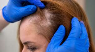 Alopecia: quando a queda de cabelo se torna um sinal de alerta