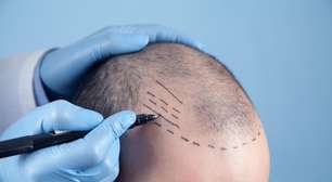 Tecnologia visa mais naturalidade em transplante capilares