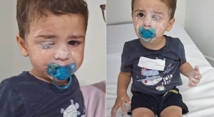 Bebê vai parar no hospital após grudar o próprio olho com Super Bonder em SC