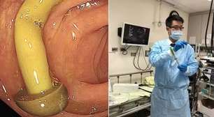 Médico encontra cogumelo crescendo em intestino de paciente; entenda