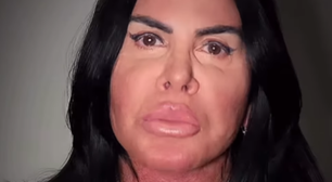 Gretchen faz nova harmonização facial e resultado surpreende; veja foto