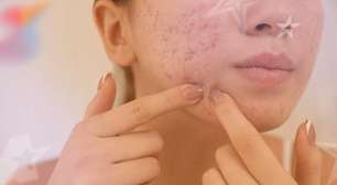 Acne na adolescência: o que é mito, o que é verdade e como tratar sem prejudicar a pele