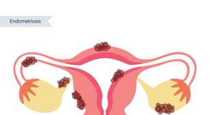Afinal, o que é a endometriose? Explicamos tudo sobre a doença que surge no útero
