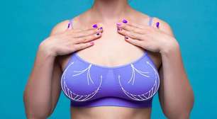Mamoplastia: conheça 3 mitos sobre o procedimento