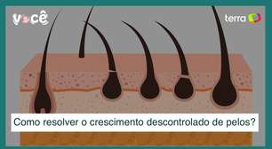 Disfunções hormonais causam crescimento descontrolado de pelos: como resolver