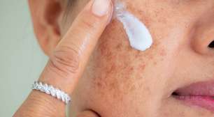 Melasma: especialista revela que clima ameno e a menor exposição solar no inverno favorecem tratamentos; veja como cuidar da pele
