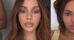 Exagerou? Após rosto 'irreconhecível' de Anitta viralizar, especialista alerta para riscos de procedimentos estéticos antes dos 35