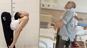 Menino com 'corpo dobrado' fica em pé e se deita pela primeira vez após cirurgia; veja vídeo