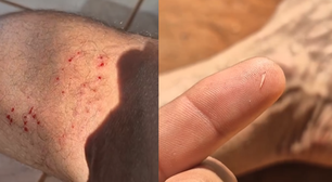 Influenciador é mordido por sucuri e dente da cobra fica preso no calcanhar; veja