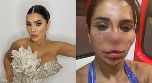 Influenciadora francesa fica desfigurada após sofrer ataque brutal por homens armados
