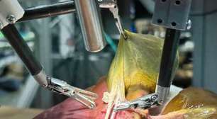 Pela 1ª vez na história da medicina, robô faz cirurgia guiada por IA sem ajuda de humano