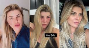 O que ex-Bbb Íris Stefanelli fez no rosto? Veja antes e depois