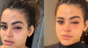 'Mosquinha parece ser inofensiva, mas não é', diz jovem que viralizou após infecção ocular