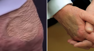 Antes de diagnóstico, Trump foi flagrado com mão maquiada e pés inchados