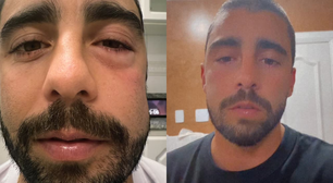 Pedro Scooby aparece com rosto inchado após procedimento e assusta seguidores; saiba motivo