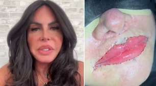 Após remover preenchimento dos lábios, Gretchen exibe resultado: 'Ficou perfeita'