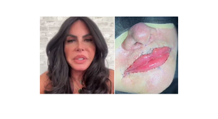 Gretchen sem PMMA! Famosa remove substância polêmica dos lábios e exibe resultado: 'Minha boca agora está perfeita'
