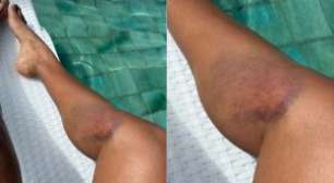 Sheron Menezzes sofre acidente e exibe hematomas após susto: 'Toda roxa'
