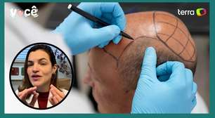 Fazer transplante capilar não significa largar os medicamentos para calvície