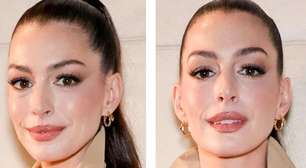 Caso Anne Hathaway: é possível fazer cirurgia plástica sem que ninguém perceba?