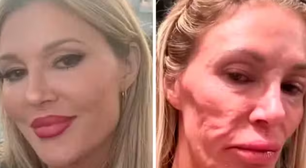 Ex-modelo sofre queimaduras graves ao tentar matar parasita que fez rosto 'derreter'; antes e depois
