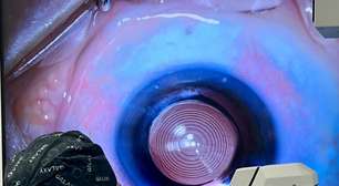 Cirurgia ocular promove independência do uso de óculos