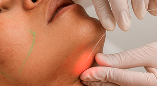 Laser subdérmico surge como alternativa à lipoaspiração