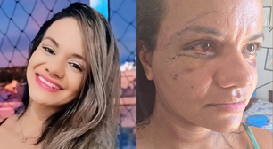 Mulher agredida com 60 socos mostra rosto uma semana após cirurgia