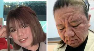 Mulher choca ao mostrar como gravidez deixou seu rosto quase irreconhecível