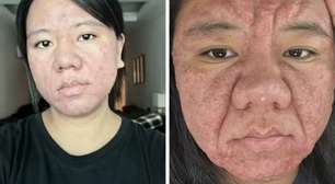 Acne gravídica: entenda a doença que transformou rosto de mulher grávida
