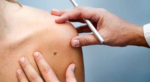 Vacina contra câncer de pele pode reduzir em até 49% o risco de morte ou retorno da doença