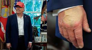 Trump volta a aparecer com maquiagem na mão após diagnóstico de insuficiência venosa crônica