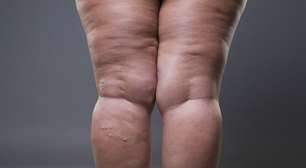 Será que é lipedema mesmo? Tire suas dúvidas aqui
