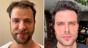 Ex-BBB Gustavo Marsengo mostra resultado 9 meses após ter feito transplante capilar: 'Um novo homem'