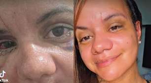 Vítima de 61 socos do ex-namorado mostra recuperação após cirurgia facial