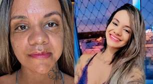 Vítima de 61 socos do ex-namorado mostra recuperação após cirurgia facial e recebe apoio nas redes