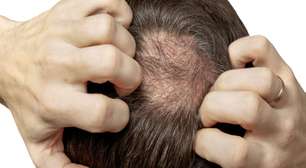 Calvície precoce: causas e impactos da perda de cabelo entre os jovens