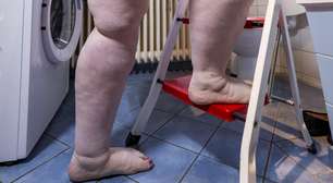 'Lipedema não é biotipo, é doença', defende cirurgiã plástica