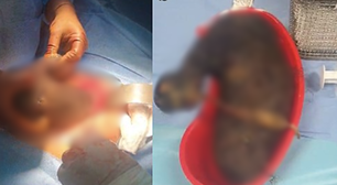 Adolescente com 'síndrome de Rapunzel' tem bola gigante de cabelo removida do estômago