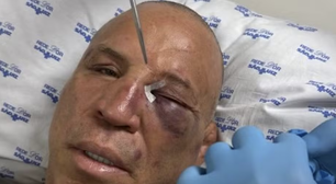 Wanderlei Silva quebra nariz e leva pontos no rosto após 'nocaute' em briga generalizada