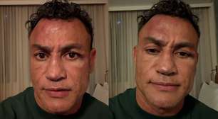 Popó mostra hematomas após cabeçadas de Wanderlei Silva