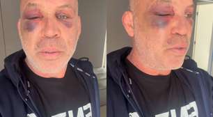 Wanderlei Silva mostra sequelas de confusão generalizada após luta contra Popó