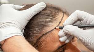 Minoxidil x Transplante Capilar: qual é a solução mais eficaz contra a calvície?