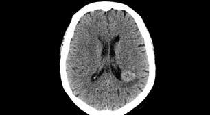 Vozes inexplicáveis salvaram mulher que tinha tumor na cabeça; entenda