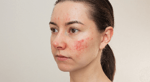 Estresse: veja como seus efeitos se refletem na nossa pele