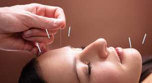 Acupuntura estética: descubra procedimento focado na beleza