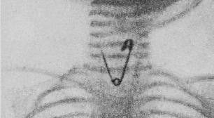 De agulhas a projéteis: a tecnologia que encontra metais perdidos no corpo