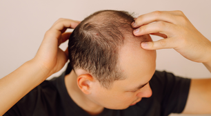 Estudo aponta: álcool e refrigerantes podem intensificar a queda de cabelo