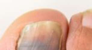 Unhas e pés do corredor: veja os cuidados para você que corre ou caminha