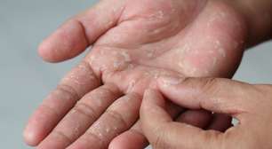 Bolhas nos pés e nas mãos pode ser disidrose; conheça problema